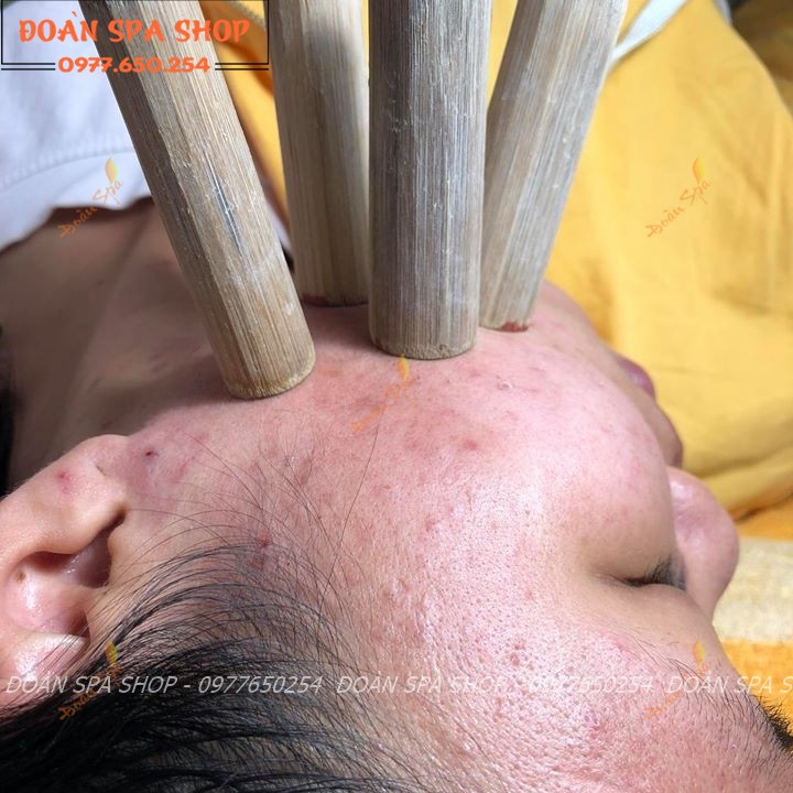 Combo 10 ống tre hút mụn - Nặn mụn lăn ống tre