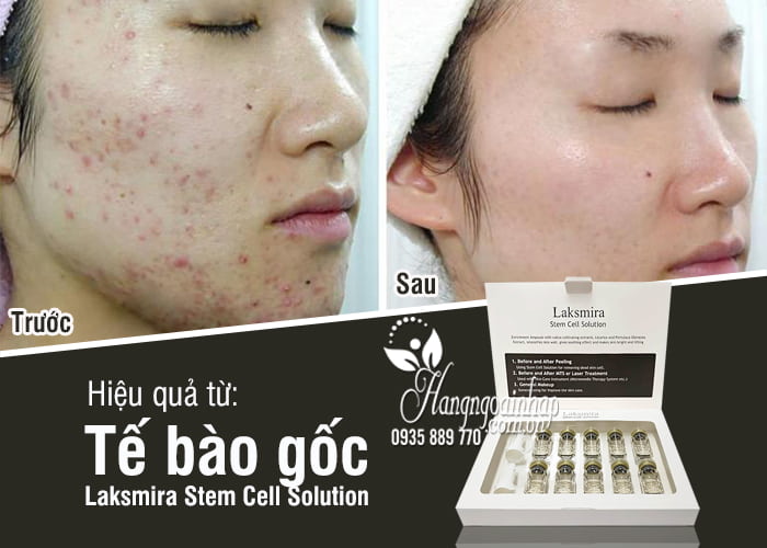 Tế bào gốc Laksmira Stem Cell Solution Hàn Quốc