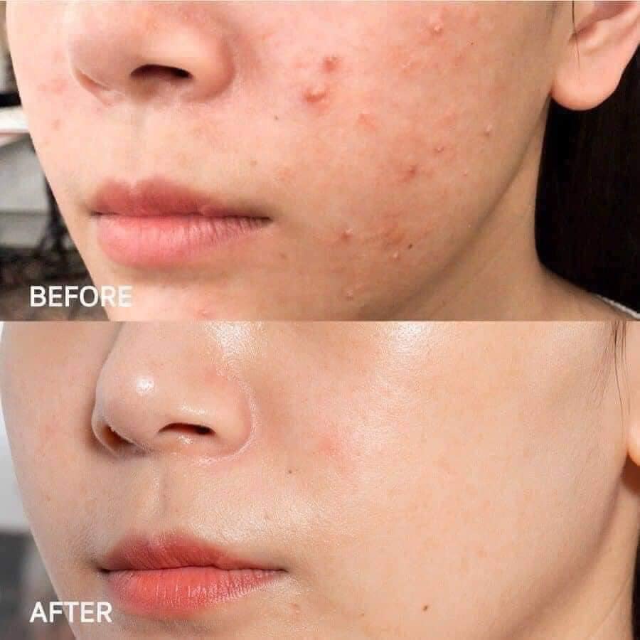 Kem dưỡng ẩm giảm mụn SVR ACTIVE GEL SEBIACLEAR 40ml