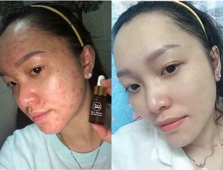 Serum Mụn MyMiu
