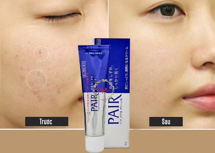 Kem trị mụn Pair Nhật Bản 24g