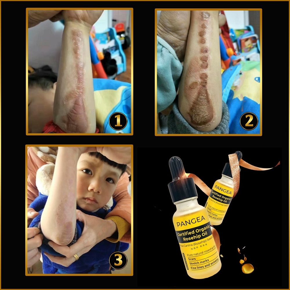 [HCM]Serum PANGEA - Xóa Sẹo Chuyên Sâu 20ml