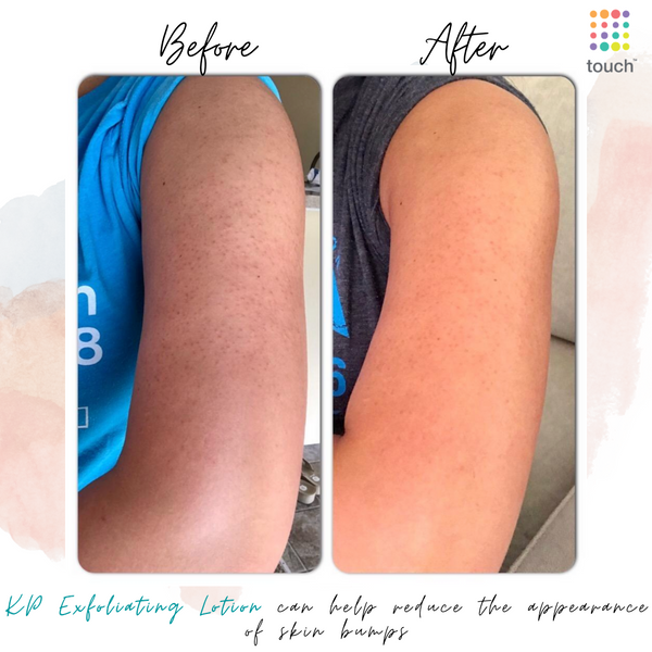 [Bill US] Kem Dưỡng Body Gold Bond Ultimate Rough & Bumpy Skin Cream