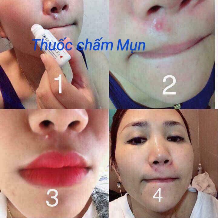 Chấm Mụn CLINDA-M 69 Thái Lan