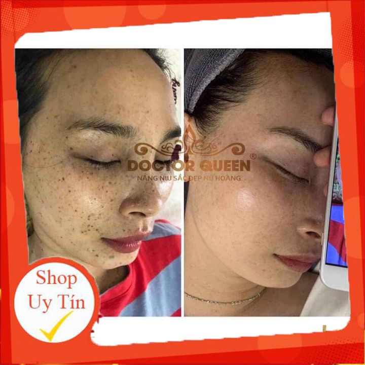 Kem Nám Doctor Queen-🔥𝐍𝐄𝐖🔥- (Ngừa Các Loại Nám,Sạm Da,Tàn Nhang,Làm Sáng Da,Đều Màu Da.,,)