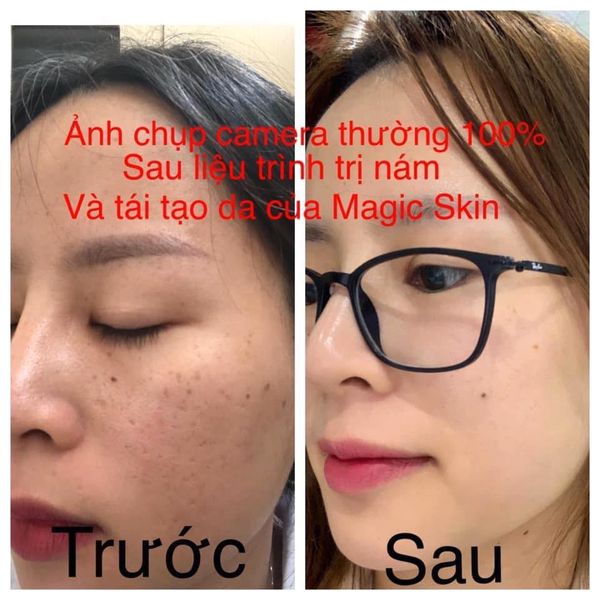 Cao Nám Magic Skin Hủ To 40gram