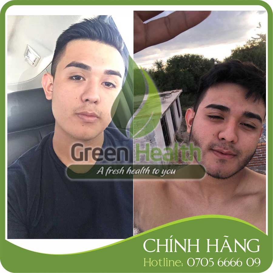 ⊙❣┇ Hộp 6 chai mọc râu tóc Minoxidil 5 dạng lỏng