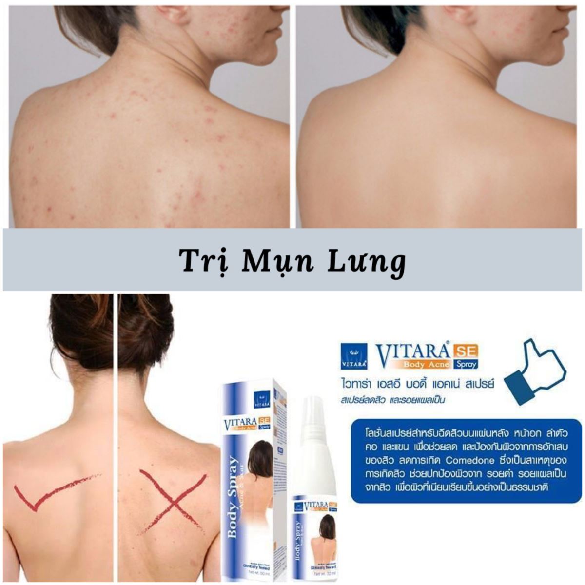 Xịt mụn lưng và ngực Vitara SE Body Acne Spray Thái Lan【Sò Market】