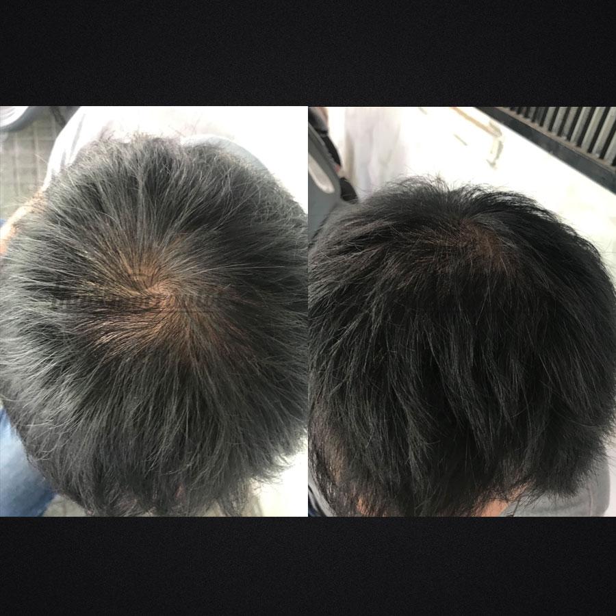 [HCM]Thuốc mọc tóc Mỹ hãng Kirkland