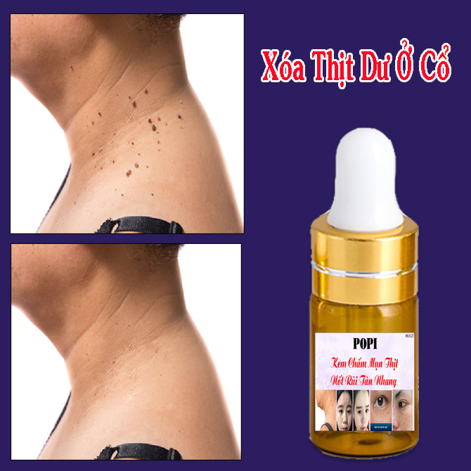 [HCM]Kem Xóa Nốt Ruồi Tàn Nhang Đồi Mồi