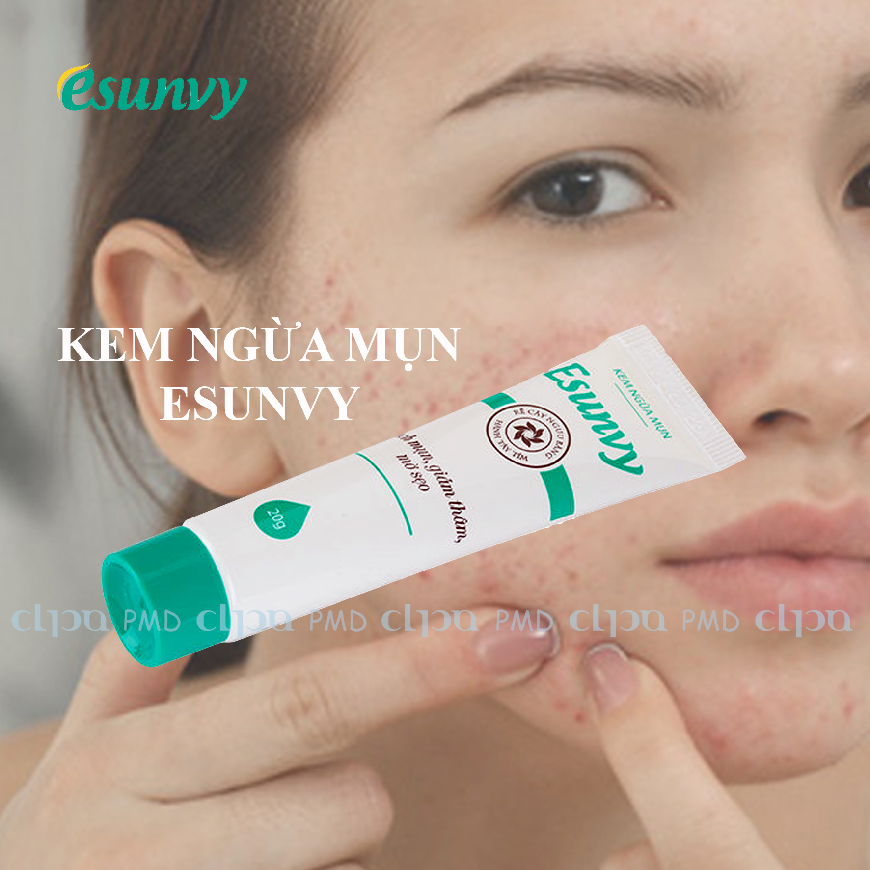 KEM NGỪA MỤN ESUNVY 20G