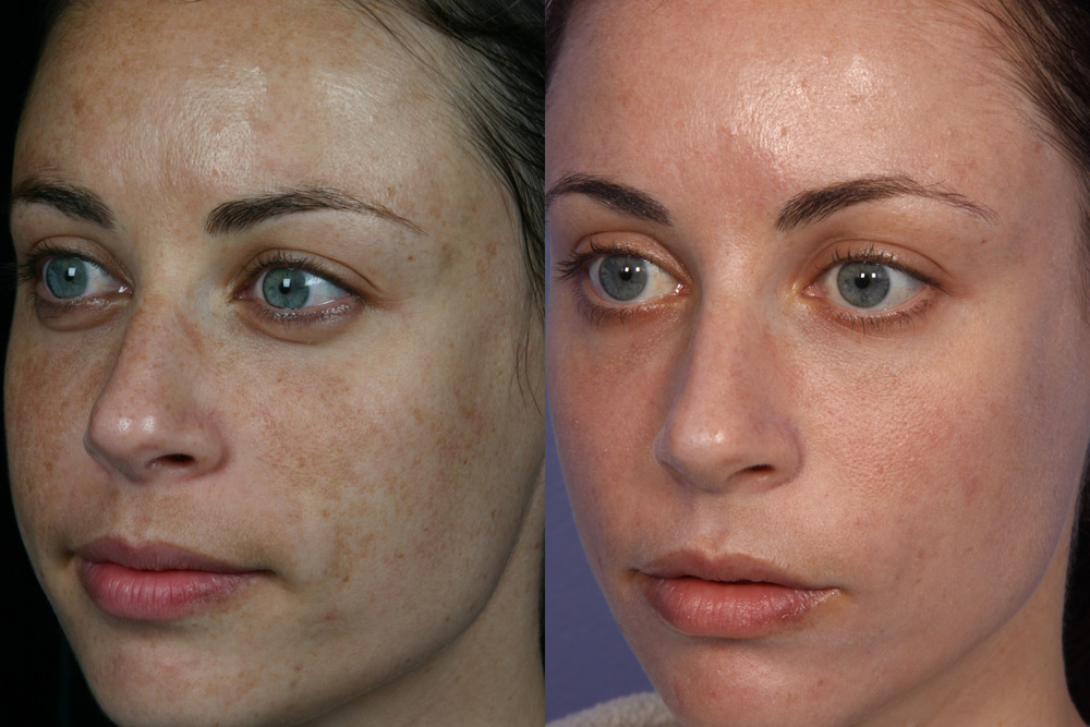 Serum tri Mụn Bọc tận gốc  Doctor Care