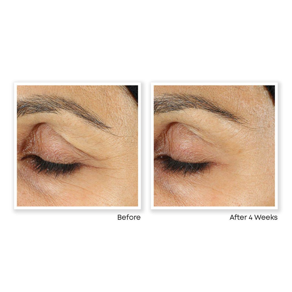 Kem mắt RoC Retinol Correction Eye Cream