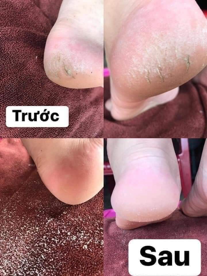 máy chà gót chân tẩy tế bào da chết chuyên dụng