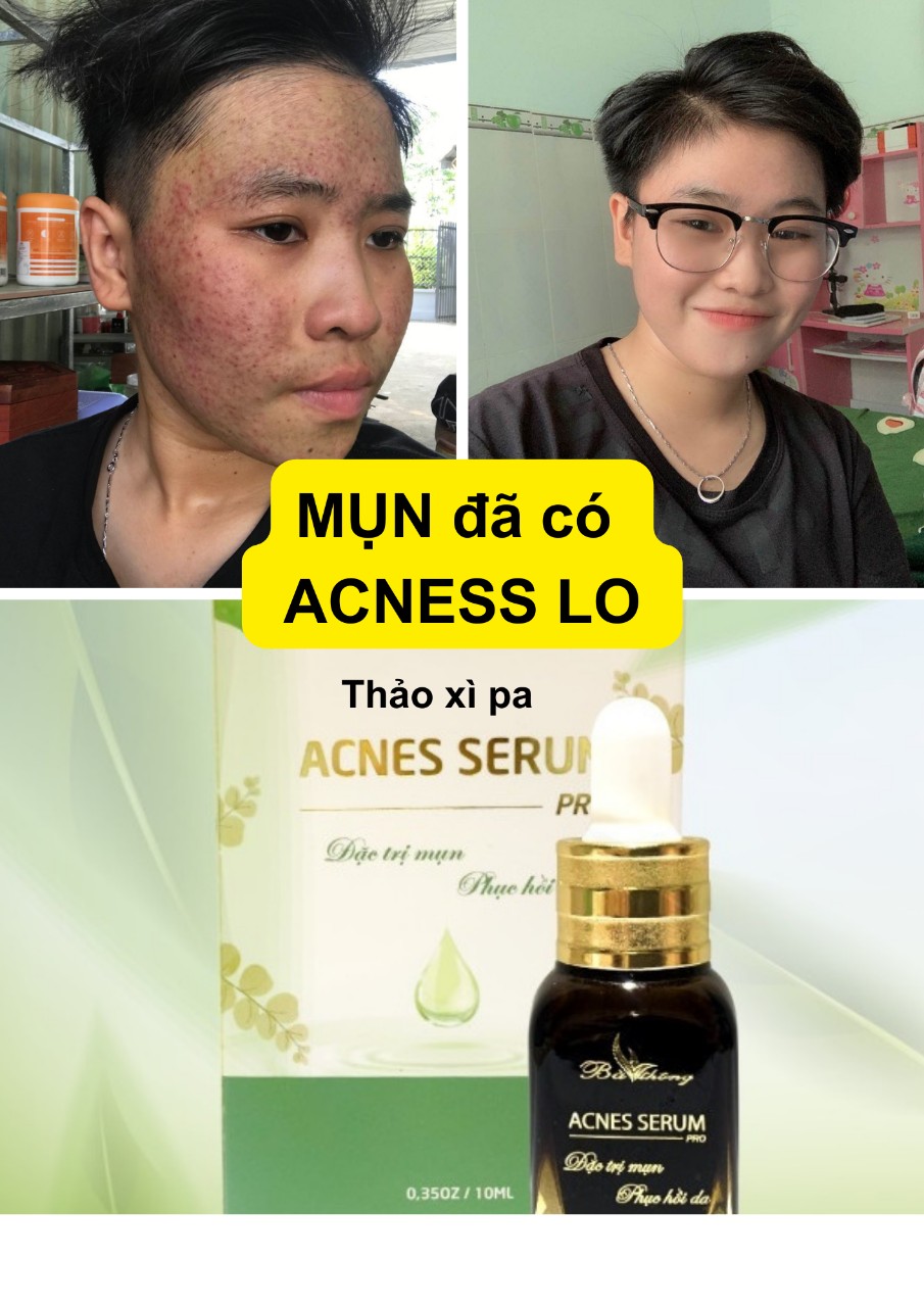 SERUM ACNES NGỪA MỤN THẢO DƯỢC