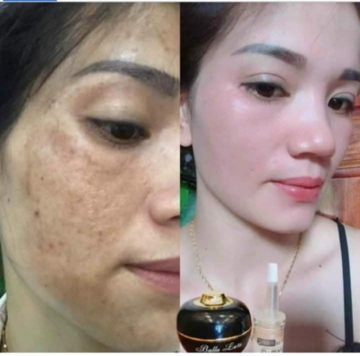 cao nám và serum Jiuhe
