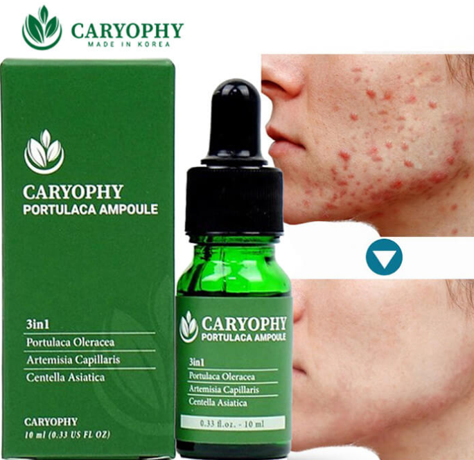 Serum Ngừa Mụn Thâm Dành Cho Da Nhờn Caryophy [KÈM VIDEO]