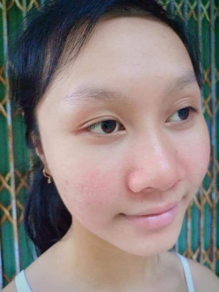 kem face mụn huỳnh đỗ