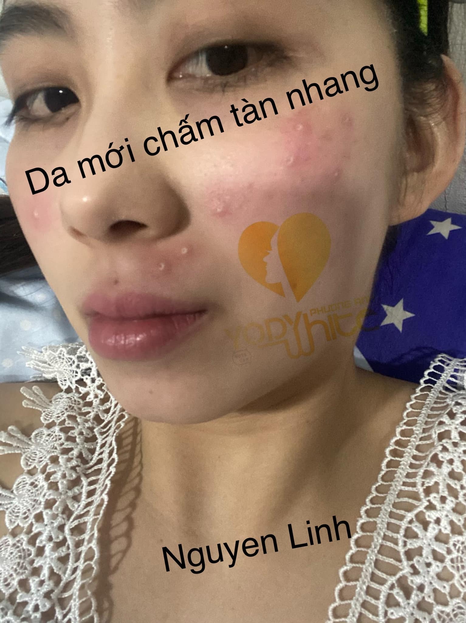 [TẶNG ẤM SIÊU TỐC +CHAI NƯỚC HOA PHÁP 20ML]-COMBO CHẤM TÀN NHANG,MỤN THỊT,MỤN RUỒI,MỤN CÓC 7 NGÀY BONG