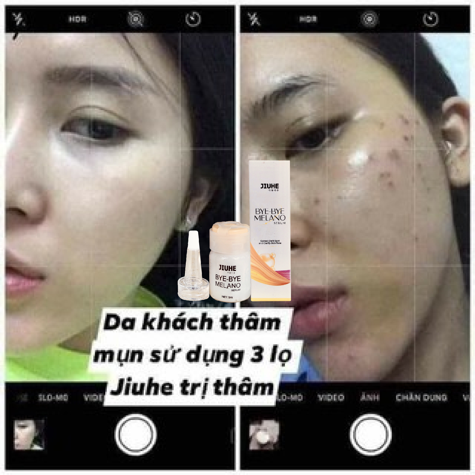 Serum xóa thâm Jiuhe 5ml