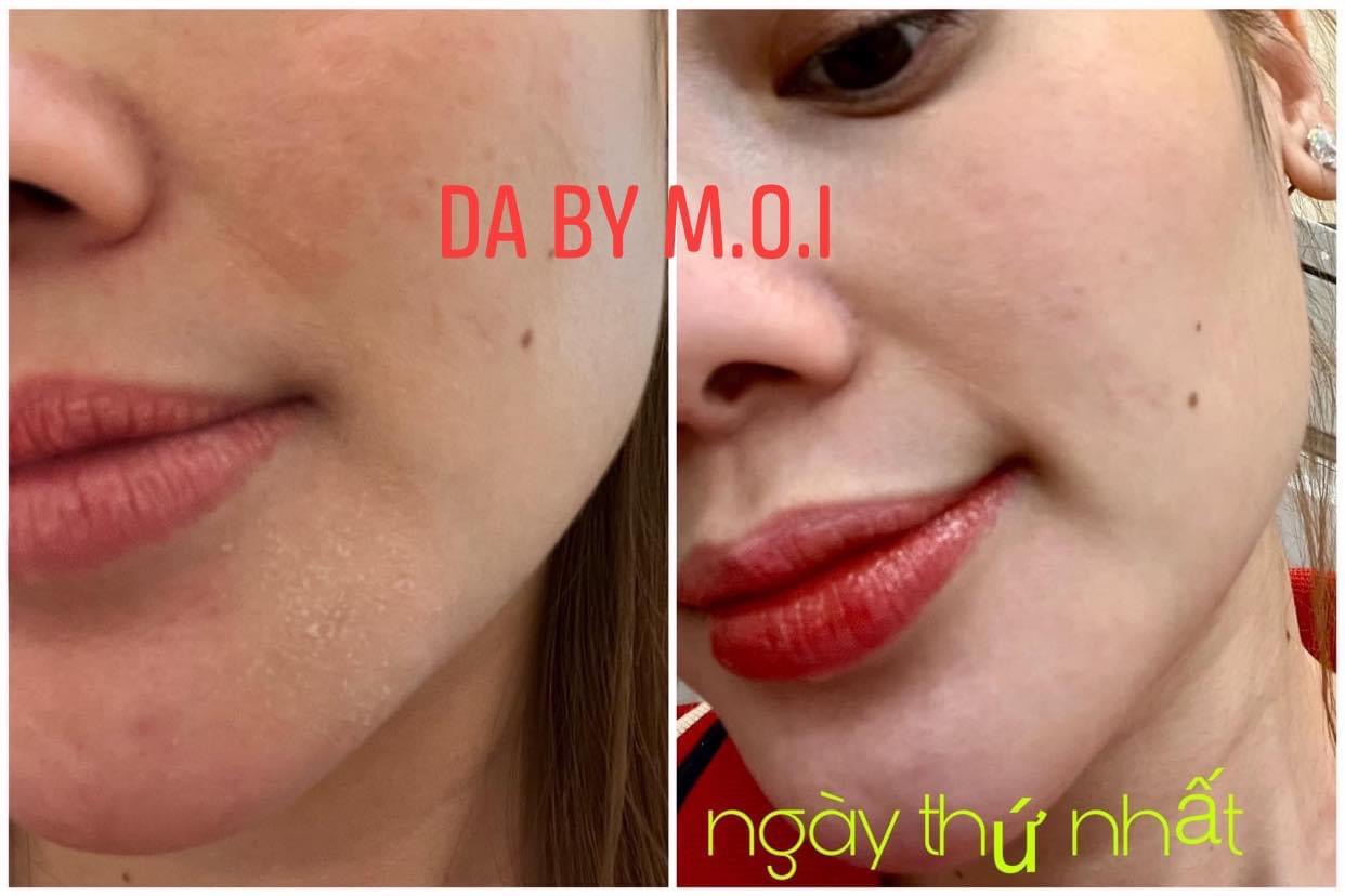 SỮA RỬA MẶT VÀ TONER DA BY MOI