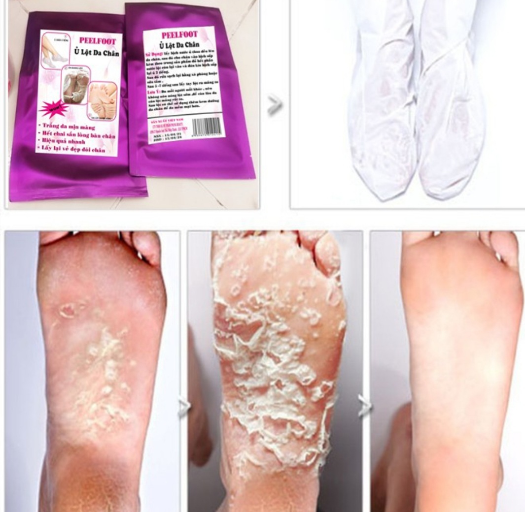 Ủ Lột Da Chân Trắng Mịn Hết Chai Sần nhám
