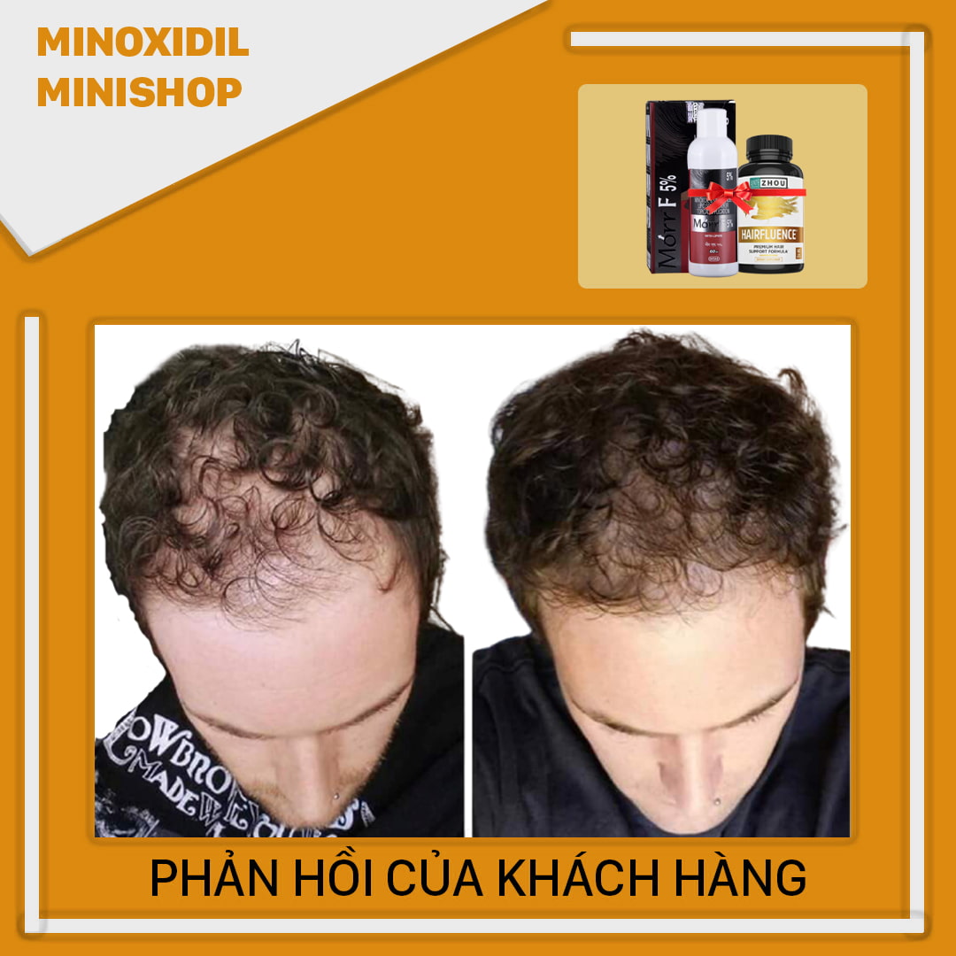 Combo Mọc Tóc Hói Morr F5 + HairFluence