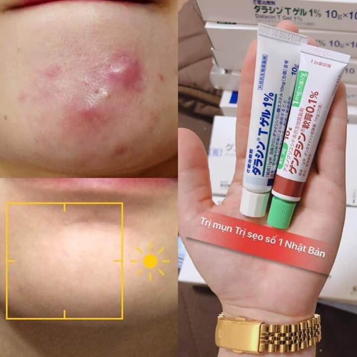 GEL TRỊ MỤN NHẬT BẢN 𝐒𝐀𝐓𝐎 𝐃𝐀𝐋𝐀𝐂𝐈𝐍 𝐓 𝐆𝐄𝐋 1%