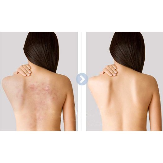 Xà phòng loại bỏ mụn lưng for back nhật