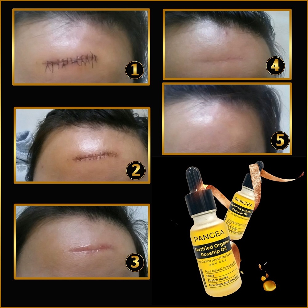 [HCM]Serum PANGEA - Xóa Sẹo Chuyên Sâu 20ml