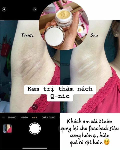 Kem Qnic Khử Thâm Nách và Bikini Thái Lan