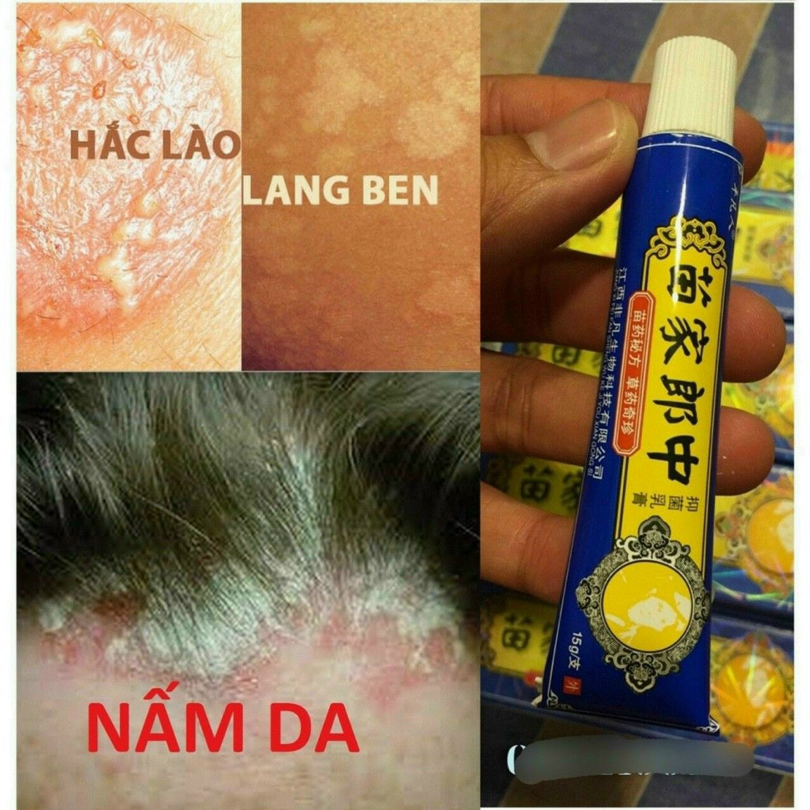 KEM BÔI DA LIỄU