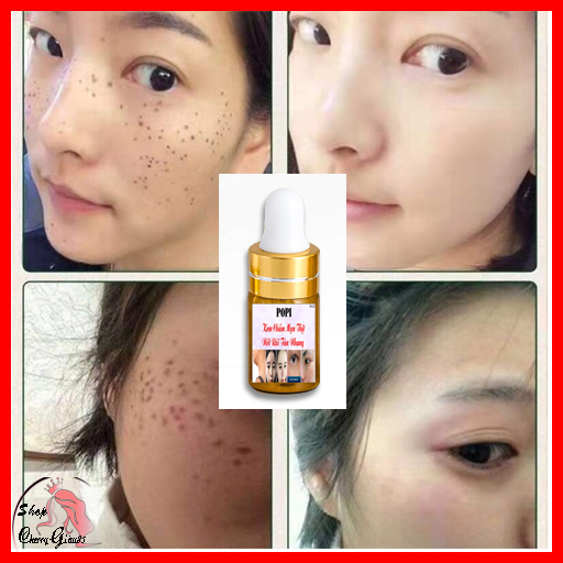 KEM TẨY MỤN CƠM, MỤN CÓC, NỐT RUỒI, MỤN THỊT, TÀN NHANG POPI