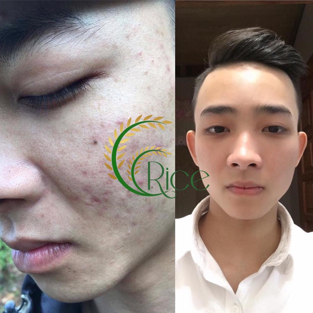 [KÈM QUÀ TẶNG] SERUM RICE MẦM GẠO NON XÓA MỤN MỜ THÂM NÁM SẠM DA