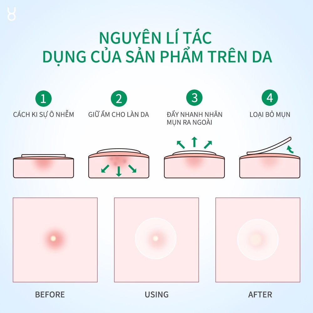 Miếng dán mụn Focalskin Acne Pimple Patch Day Night (60 miếng)