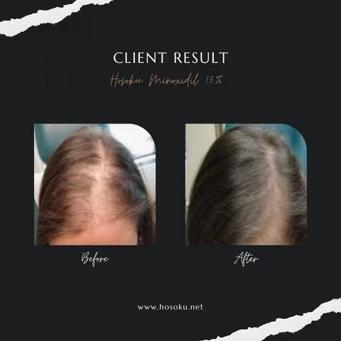 Dầu thầu dầu mọc tóc Minoxidil hosoku 15