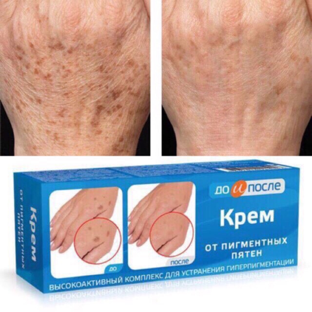 [HCM]Kem  đồi mồi tay Nga