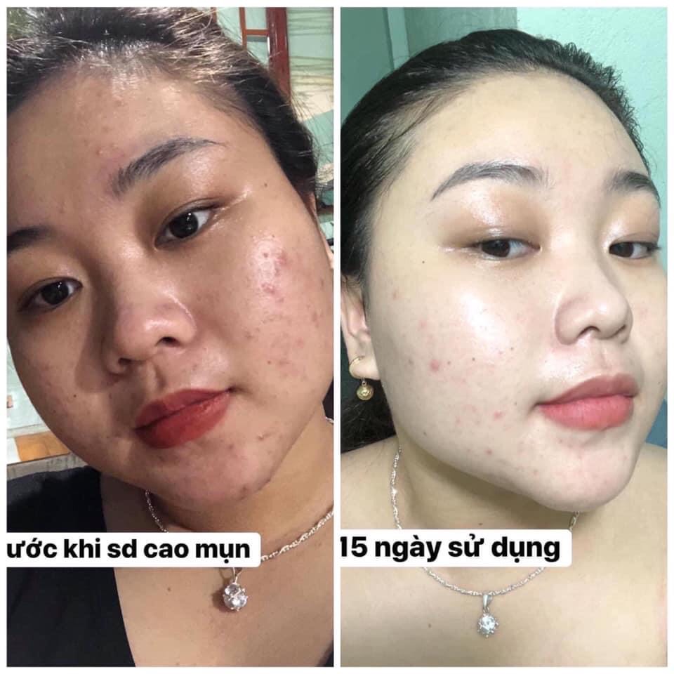(CAO MỤN SÂM ĐỎ- CHẤM DỨT MỤN SAU 14 NGÀY FULL 15GR