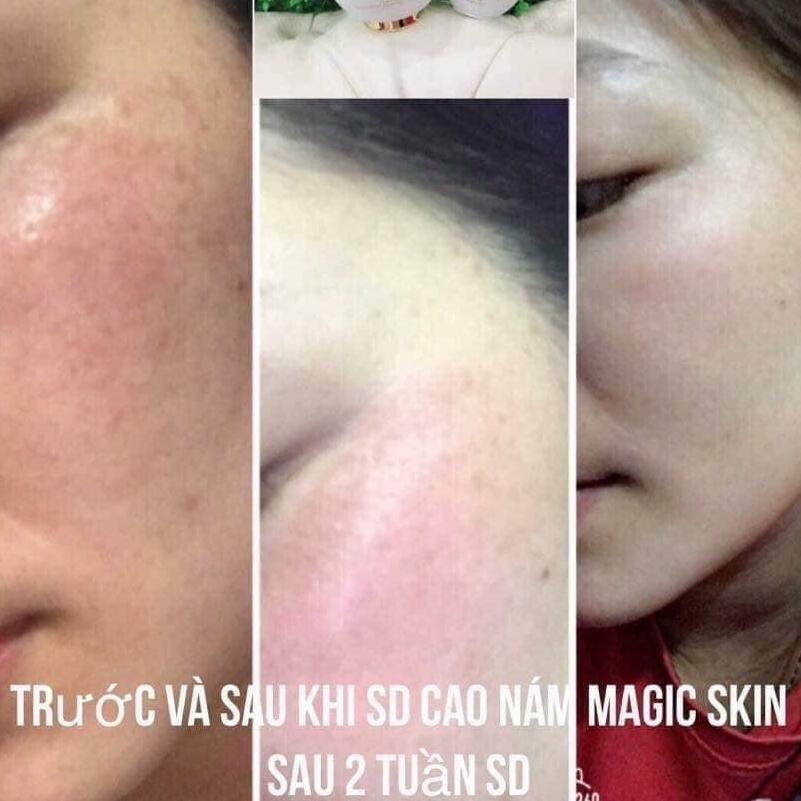 KEM NGỪA NÁM TAN NHANG MAGIC SKIN