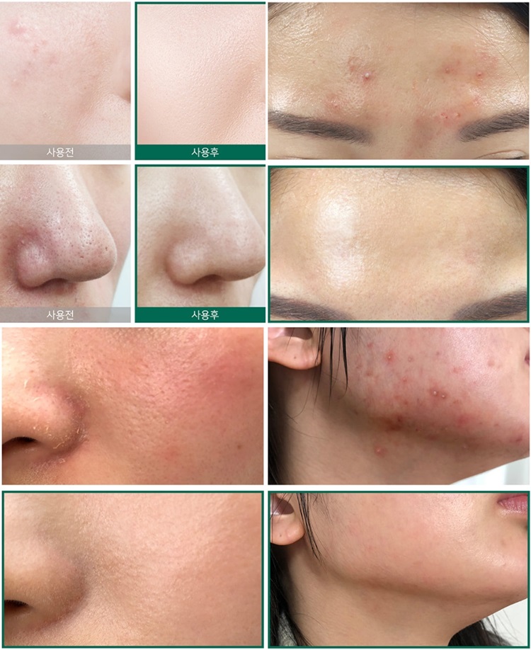 [HCM]Tinh Chất SOME BY MI Cho Da Mụn 50ml AHA-BHA-PHA 30 Days Miracle Serum