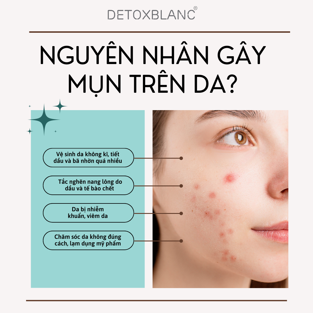 Combo 2 chai Serum Mụn Lộc Đề H 30ml - Peel Acnes Blanc H