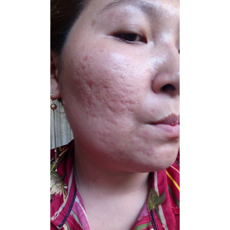 [HCM][XÃ KHO SALE OFF] Chấm Xóa Nám Rỗ Tàn Nhang YODY WHITE (Chính hãng - Số lượng có hạn)