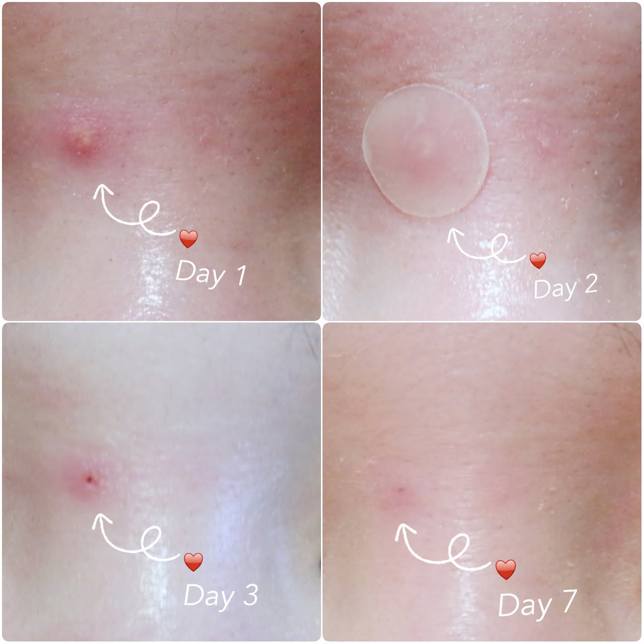 Miếng dán mụn COSRX Acne Pimple Master Patch 24 miếng/ gói