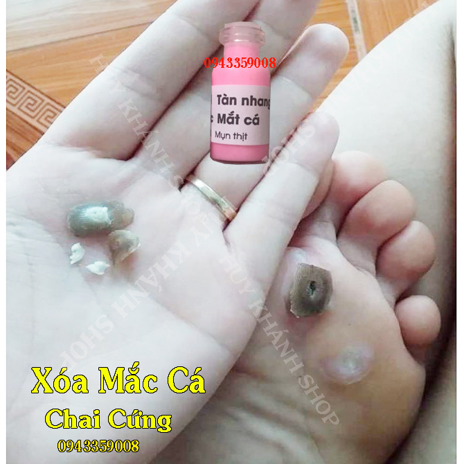 XOA NOT RUOI, TAN NHANG , MUN COC, MUN THIT