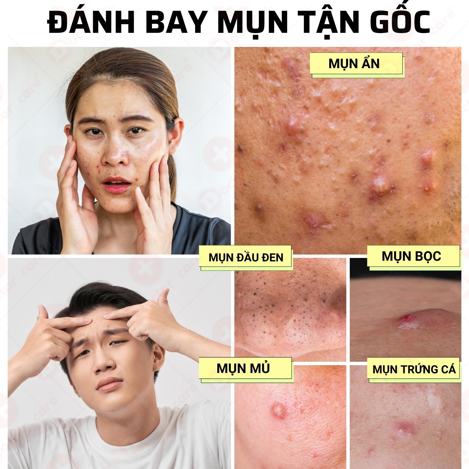Bộ Giảm Mụn Mờ Thâm Doctor Care Dành Cho Da Dầu( serum giảm mụn +kem giảm mụn Acnes Elimination Cream )