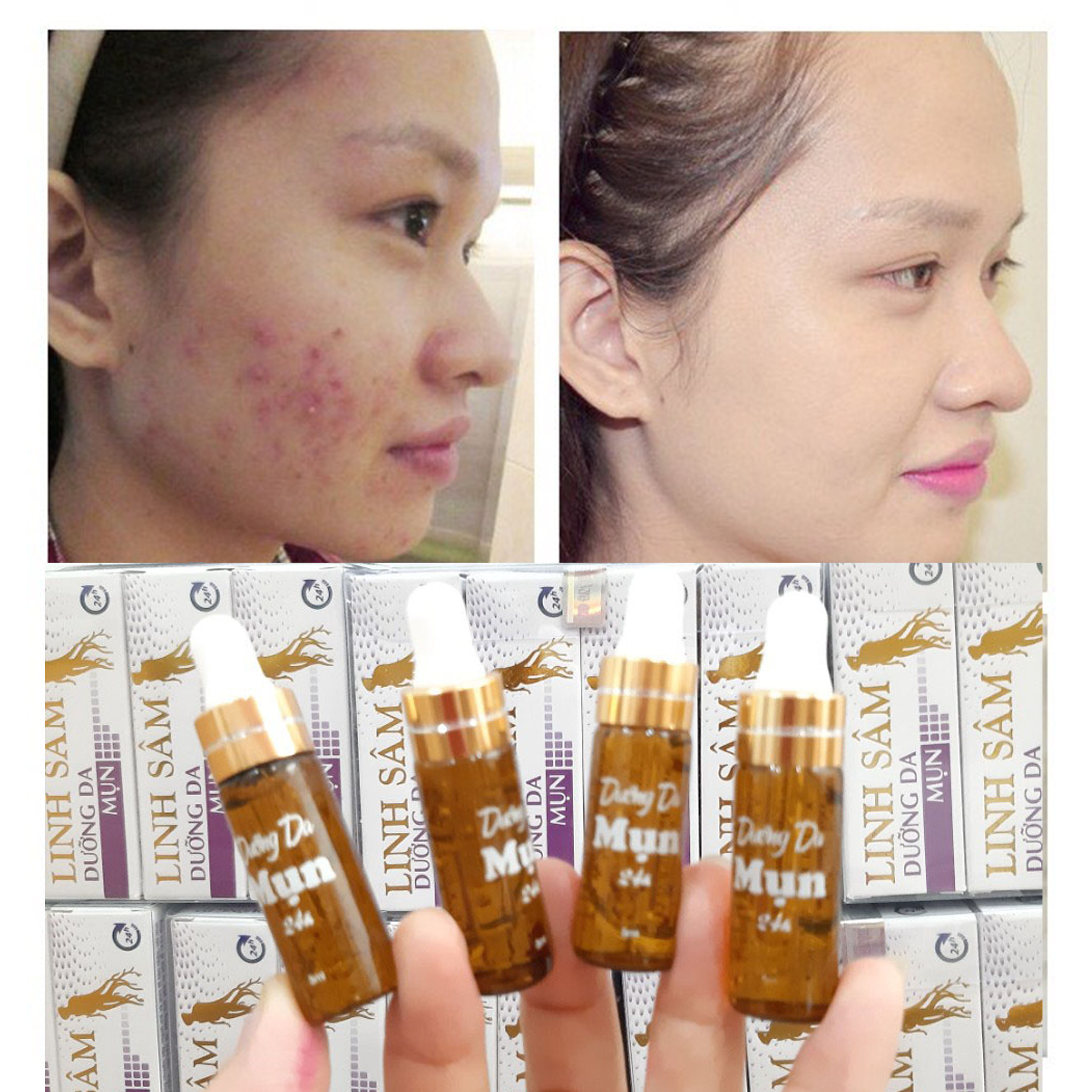 SERUM MỤN CẤP TỐC 24H LINH SÂM - chấm mụn
