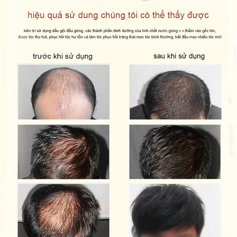 Tinh chất mọc tóc tinh dầu mọc tóc 30ml serum kích mọc tóc chăm sóc tóc chống rụng tóc,kích thích tóc mọc dà