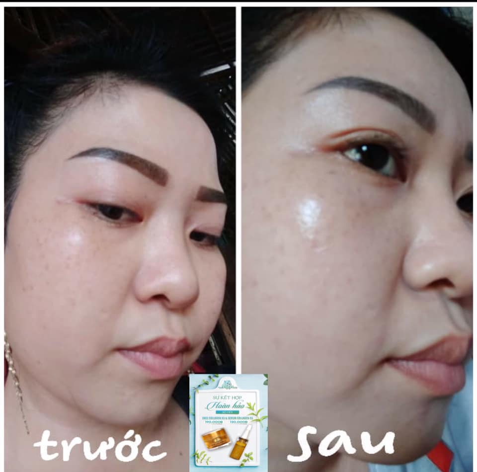 [HCM]Combo Kem Face X3 Và Serum Dưỡng Collagen X3