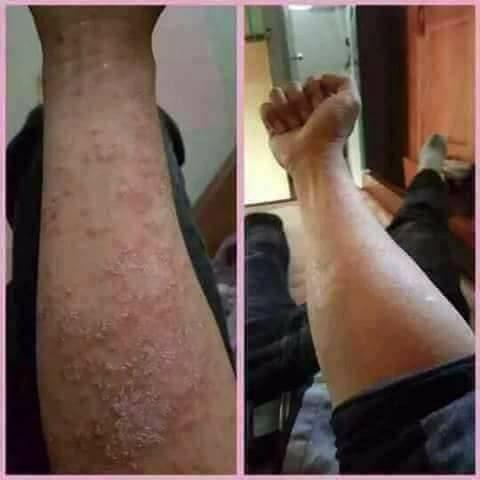 [HCM]Kem bôi da liễu