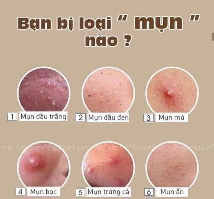Kem mụn Spa Acne